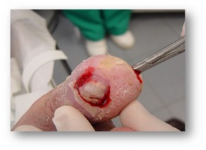 herida abierta con osteomielitis1