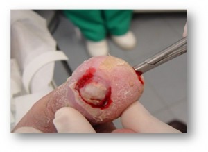 herida-abierta-con-osteomielitis
