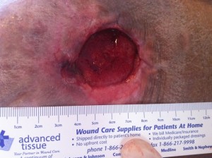 En esta  foto se observa una úlcera por presión, nótese que es una úlcera profunda y que los bordes no están adheridos debido a la mala técnica en el movimiento del paciente.